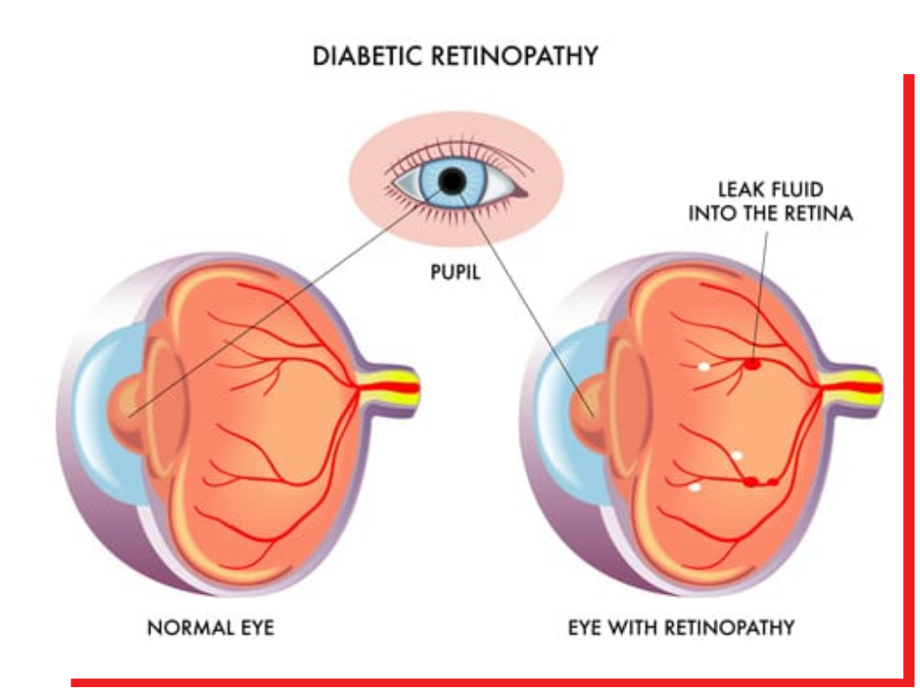 diabetic-retinopathy-2_orig