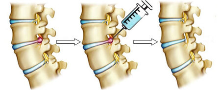 how-it-works-back-pain