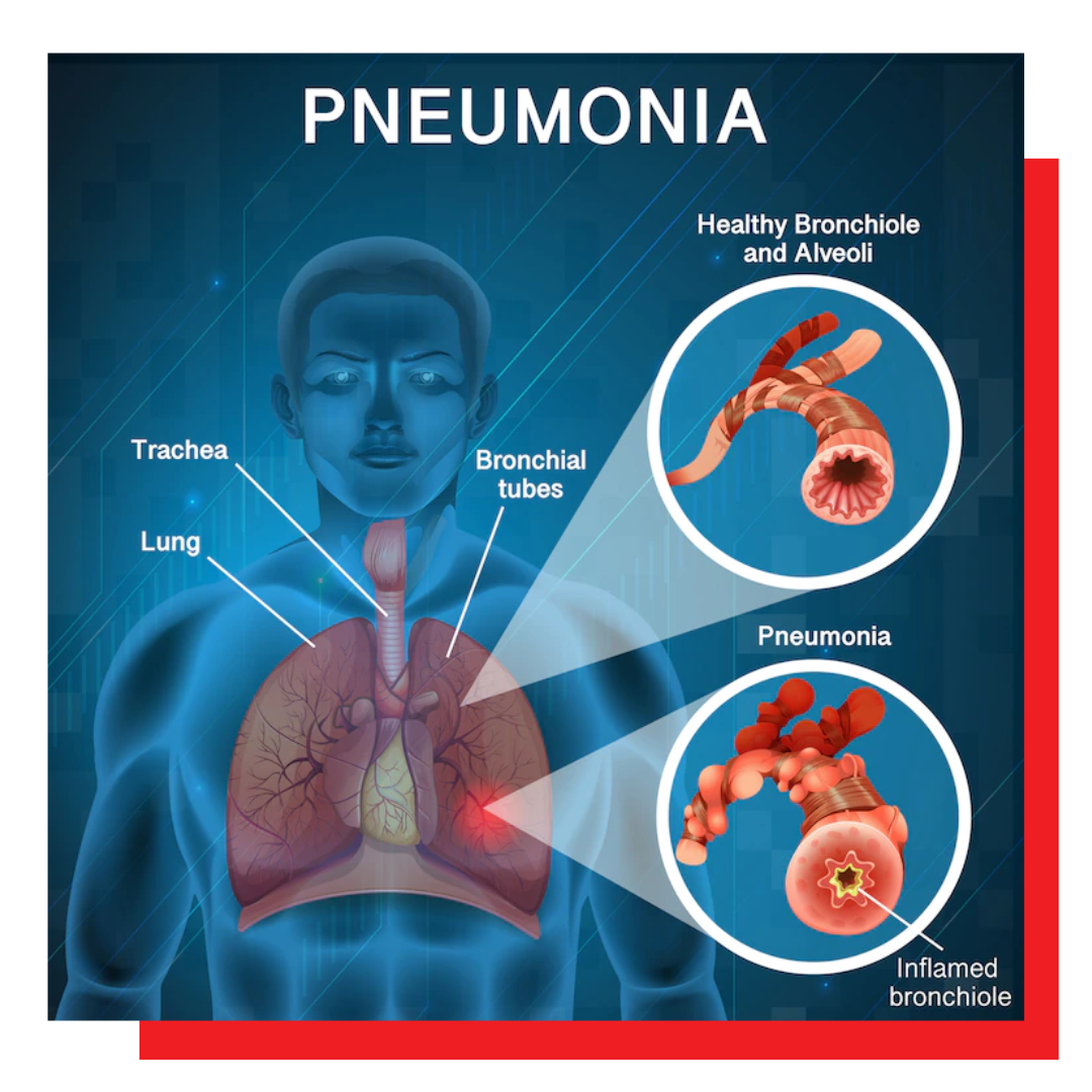 PNEUMONIA/ASTHMA DISEASE - Cell Tissue Technology